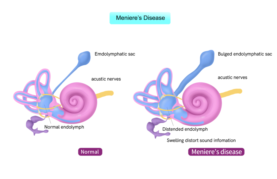 a normal without meniere's disease and an ear with meniere's disease