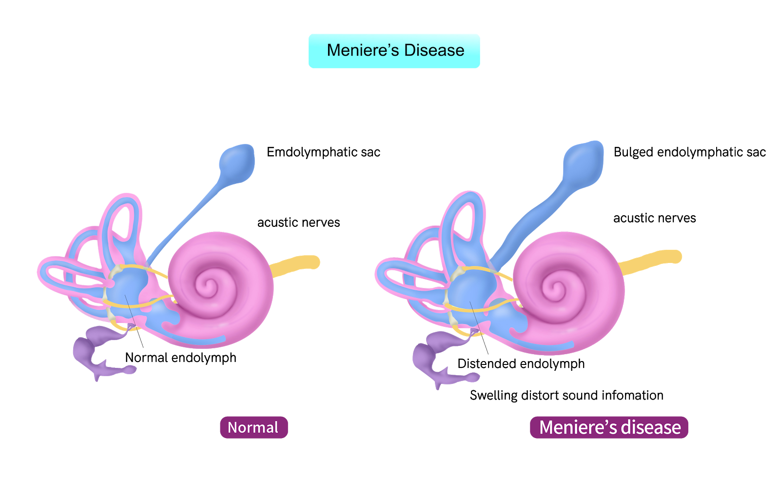 Meniere’s Disease History, Symptoms and Relief AudioCardio