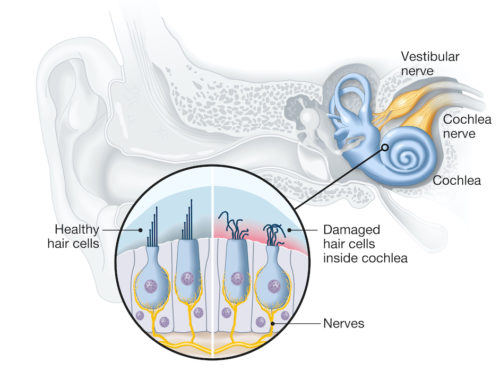 Healthy-and-damaged-hair-cells-in-the-ear