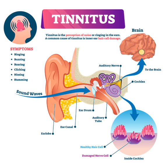 Tinnitus-diagram